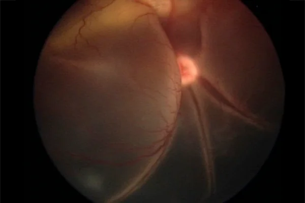 An ocular image showing a close-up view of a pet’s retina with retinal detachment.